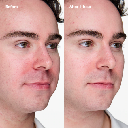 Anti-Blemish Solutions Clinical Advanced Clearing Gel